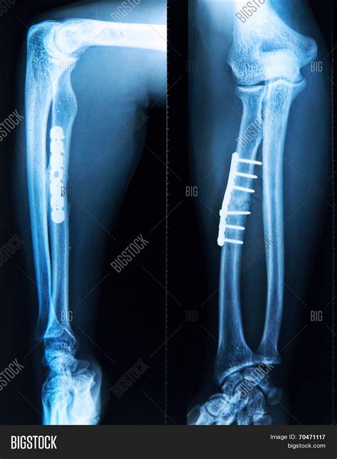 Broken Leg X Ray