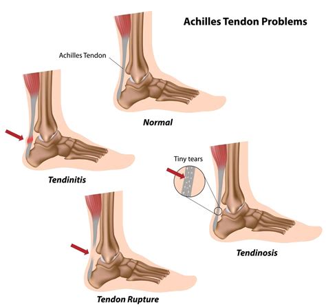Achilles Tendon Injuries and Ruptures | Dallas Podiatry Works