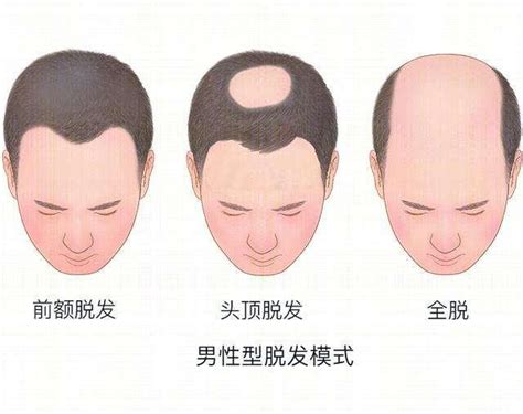 植发医生李会民：休止期脱发和雄脱有什么区别？ - 知乎