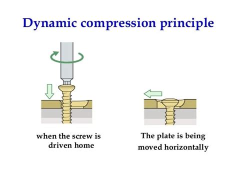 Limited Contact Dynamic Compression Plate 的图像结果