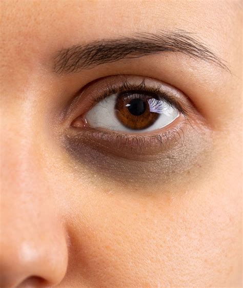 How to Get Rid of Dark Circles Permanently