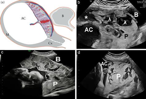Placental lakes vs lacunae: spot the differences - Jauniaux - 2024 ...