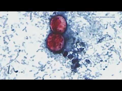 What to know about Cyclospora, explosive diarrhea parasite, outbreak in Harris County