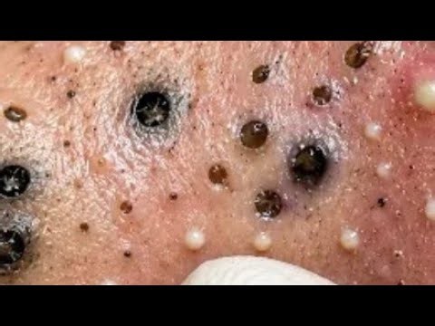 Deep blackhead Removal 2026, acne removal spa, big pimple 2026, #acne #pimple #cyst