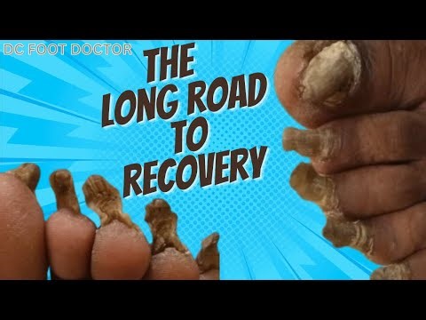 Long Road To Recovery - Trimming Fungal Toenails on a Stroke Patient