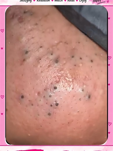 Blackhead Extraction & Satisfying Popping | Wait for the most satisfying pop 😳🫣 You won’t believe what comes out! #pimplepoppersatisfying #Acne #pimple #Blackhead #Satisfying