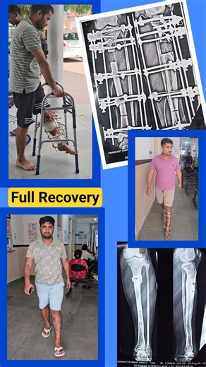 Prashant ji ke Tibia bone Fracture ki ilizarov Surgery se Full Recovery Journey #ilizarovsurgery