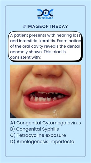 Hearing Loss + Interstitial Keratitis + Hutchinson Teeth | Spot Diagnosis | NEET PG