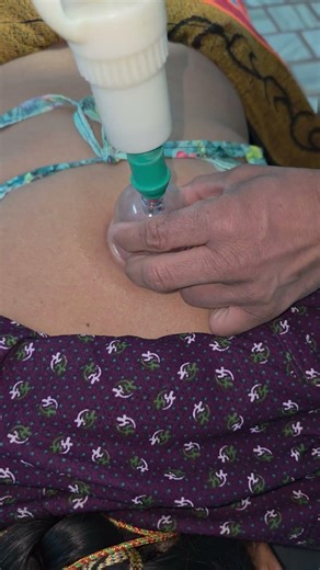 hijama ke fayde | scapula pain