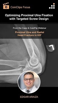 Optimizing Proximal Ulna Fixation with Targeted Screw Design