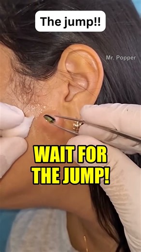 This Blackhead JUMPED Out Of His Ear 😱 #shorts #pimplepopping