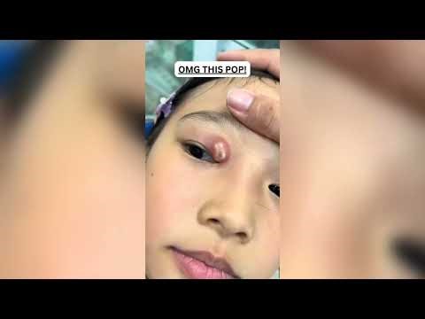 Popping huge blackheads and Pimple Popping - Best Pimple Popping Videos 310