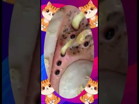 Blackheads Removal #116 | Acne Treatment and Very Satisfying Satisfying Pimple pop #blackheads