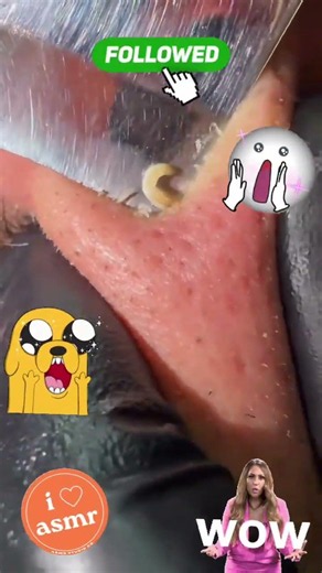 Blackheads being popped #acne #asmr #gross #pimple #pop #satisfying #skincare #trending #blackheads