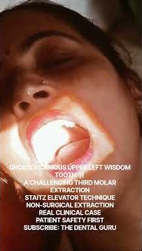 Difficult Upper Wisdom Tooth Extraction Without Surgery! 🦷Real DentalCase #TheDentalGuru#dentalcare