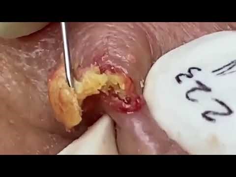 2026 NEW VIDEOS: Giant Blackhead Removal and Inflamed Pimple Extraction