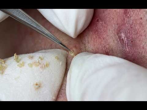 NEW 2026 - Deep Pore Cleansing: Removing Inflamed Acne & Cystic Blackheads#10381