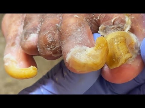 Thick And Curled Nails, Completely Demolish The High Rise【Podiatry Clinic】