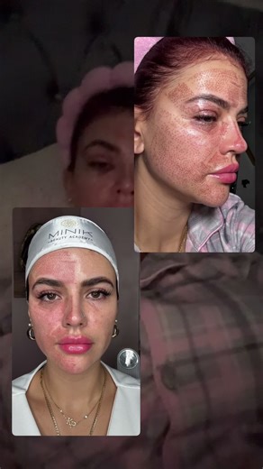 Mi proceso de fibroblast