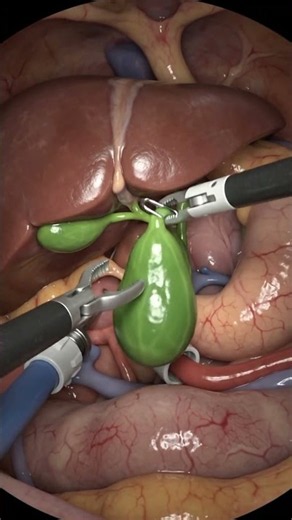 How Gallbladder Is Removed? | Laparoscopic Gallbladder Surgery Explained | Gallstones Treatment