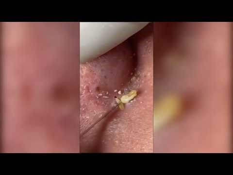 Pimple Popping - Ultimate Pimple Popping Compilation#103