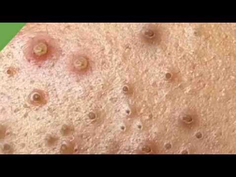Deep blackhead Removal 2026, acne removal spa, big pimple 2026, #acne #pimple #cyst