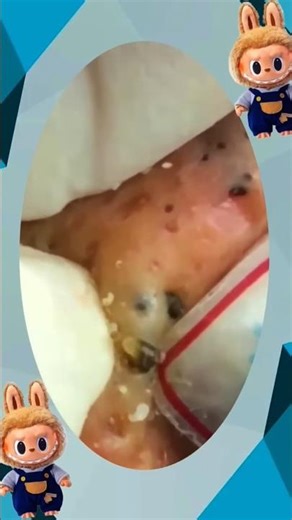 Blackheads Removal #310 | Acne Treatment and Very Satisfying Satisfying Pimple pop #blackheads