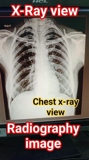 Chest X-Ray || Radiography image #xray #shortvideo #bone #mbbs Mr. ShubhamGyan