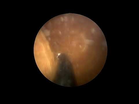 BLADDER STONE - ENDOSCOPIC SURGERY