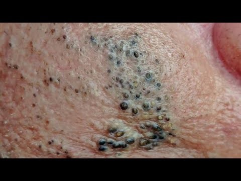 Deep blackhead Removal 2025, acne removal spa, big pimple 2025, #acne #pimple #cyst