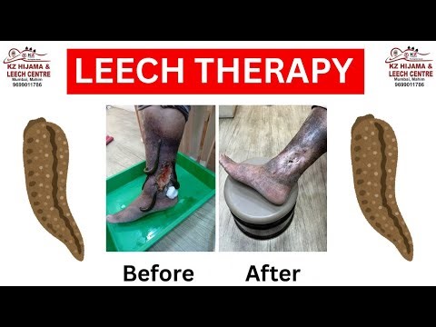 Can leeches help heal wounds? / Does leech healing work? ( LEECH THERAPY MUMBAI )