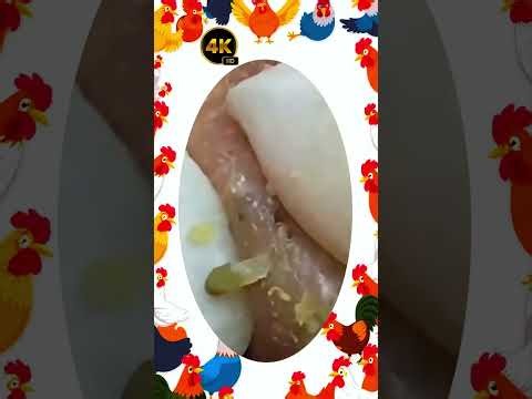 Blackheads Removal #637 | Acne Treatment and Very Satisfying Satisfying Pimple pop #blackheads