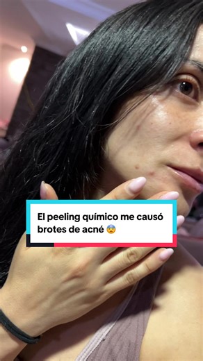 Síguenos si quieres conocer sobre química cosmética y protocolos clínicos. Únete a nuestra red de profesionales #peelingquimico #acne #acnetreatment #manchas