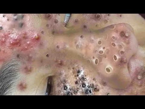 Deep blackhead Removal 2026, acne removal spa, big pimple 2026, #acne #pimple #cyst