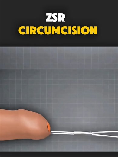 ZSR Circumcision (3D Animation) Disclaimer: This video is for educational purposes only and is intended to raise awareness about medical procedures. It does not violate TikTok community guidelines and contains no graphic or harmful content. #ZSRCircumcision #CircumcisionProcedure #StaplerCircumcision #ZSRStapler #CircumcisionSurgery