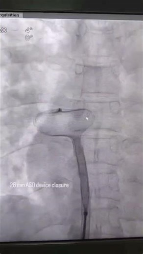 ASD device closure ❤️ | Hole in heart treated without surgery! #HeartCare#ASD #ASDClosure #HeartHole