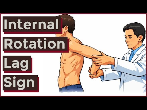 Internal Rotation Lag Sign | Subscapularis Tear