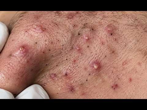 NEW 2026 – Huge Blackheads & Satisfying Acne Extraction#10367