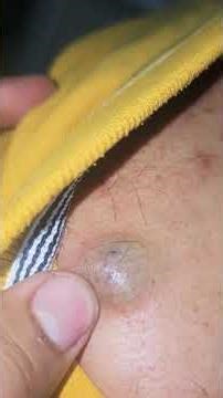 Sebaceous Cyst #imwell