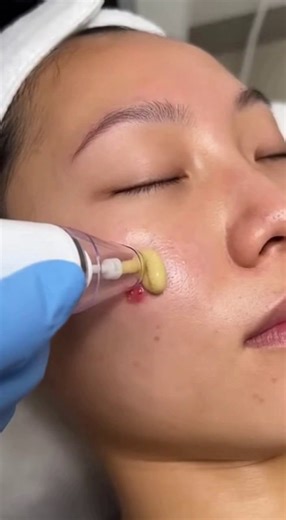 Effective Blackhead Removal for Clear Skin