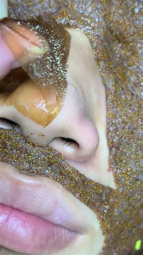 Deep Nose Blackhead Removal 😱 | Super Satisfying Skin Cleaning