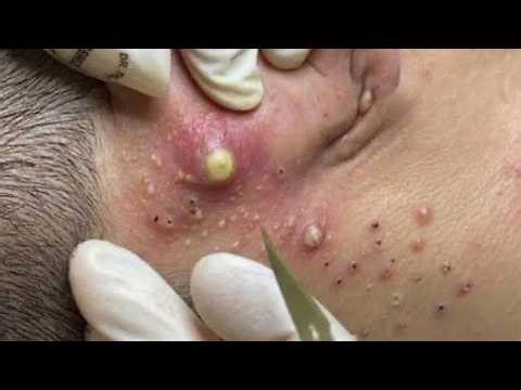 Feel The Extraction Through The Screen | Pimple Popping #800195