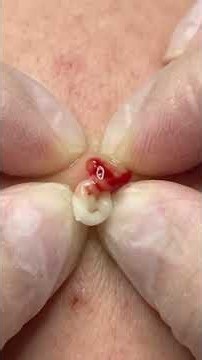 Huge Pimple Popping🌋