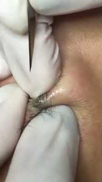 Pimple Popping and Black Head Extraction #pimple #blackheadcaique