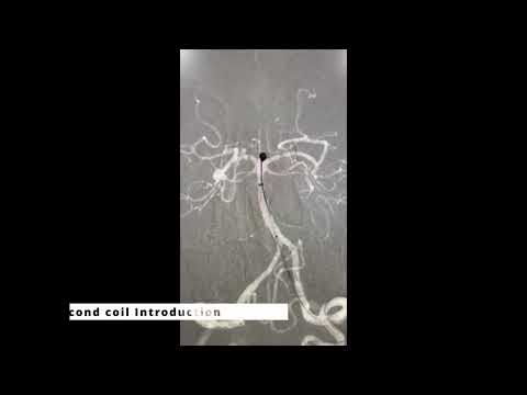 Endo vascular -Basilar top aneurysm coiling