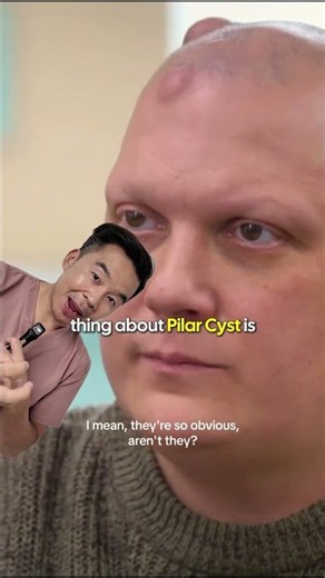 What Are Pilar Cysts on the Scalp?