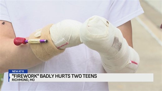 Missouri teen blows off hands in fireworks accident | Haystack News