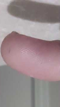 Morgellons morphs into a new solid state