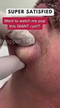 Removing large blackheads and pimples from face new 2026 #200