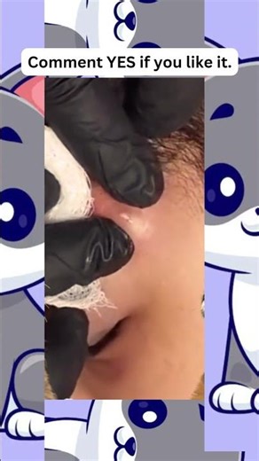 🔥Deep Blackheads, Milia & Whitehead Removal pimple popping New| Big Cystic Acne Extraction